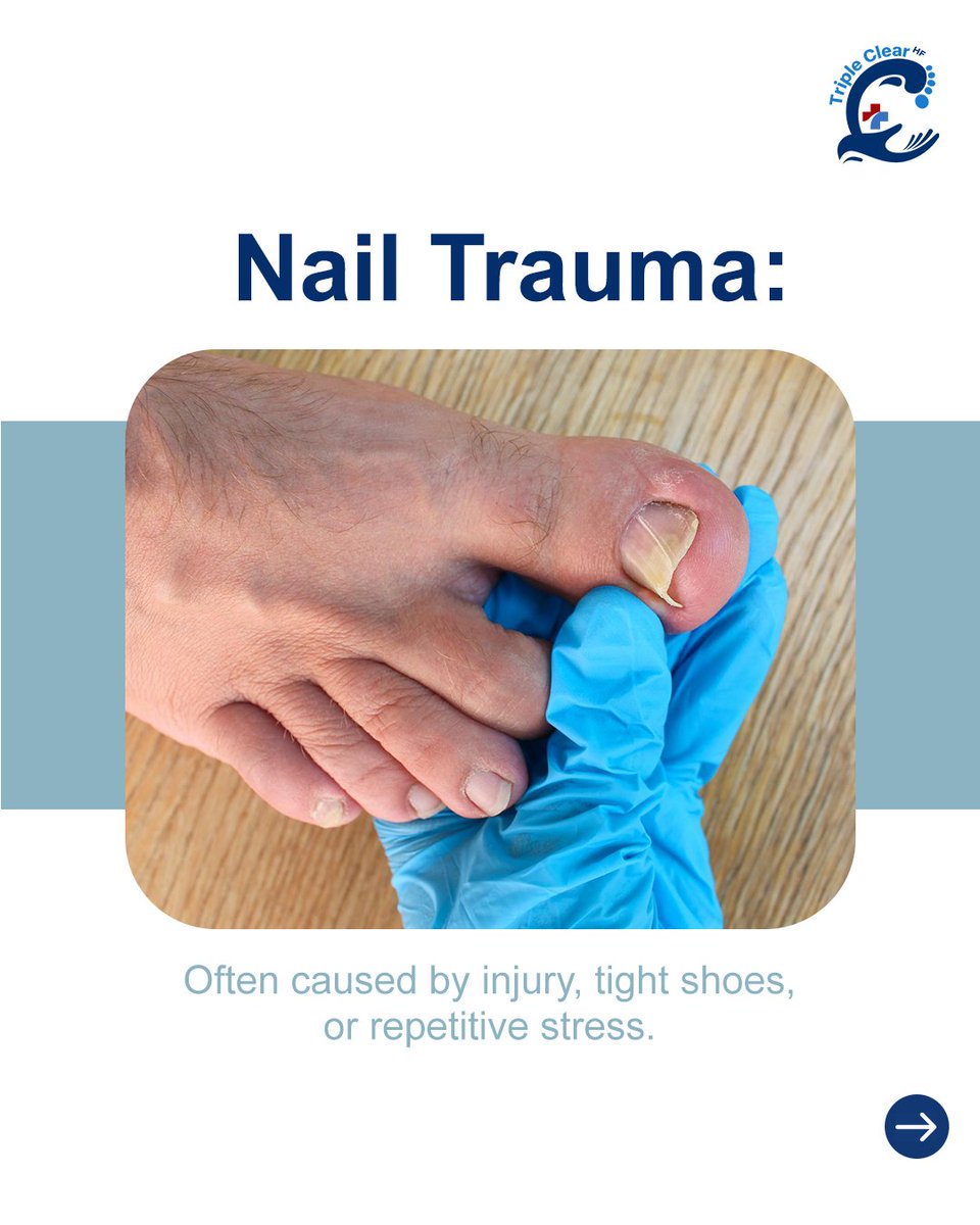 TripleClearHF's tweet image. Bruised or infected? Learn what’s really going on with your nails.

Whether it’s trauma or fungus, Triple Clear HF tackles both with all-natural, fast-acting care.

🦶 Regain your confidence.

#TripleClearHF #NailFungus #FootHealth