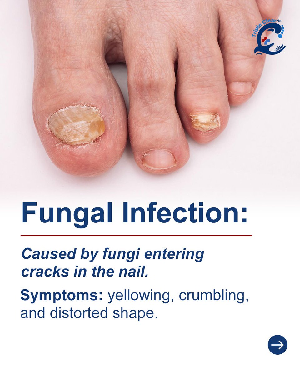 TripleClearHF's tweet image. Bruised or infected? Learn what’s really going on with your nails.

Whether it’s trauma or fungus, Triple Clear HF tackles both with all-natural, fast-acting care.

🦶 Regain your confidence.

#TripleClearHF #NailFungus #FootHealth