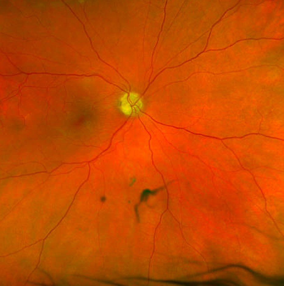 Posterior vitreous detachment and mild epiretinal membrane in an eye with optic nerve pallor due to anterior ischemic optic neuropathy.