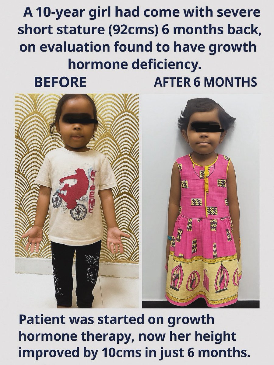 endodocsfa's tweet photo. 🌟 Patient Success Story at Sehat Hospital 🌟

A 10-year girl visited us 6 months ago with severe short stature.
On detailed evaluation, she was diagnosed with Growth Hormone Deficiency.

✅ Started on Growth Hormone therapy
📈 Height increased by 10 cm in just 6 months https://t.co/eCBQTZCWNt