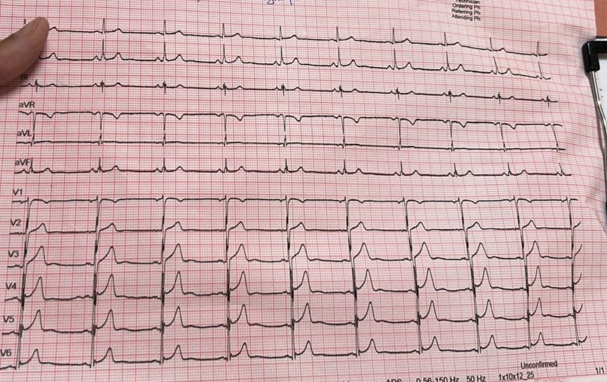 A colleague sent it to me

39 yr M, No past History 

Presentation: Syncope 

Your opinion on ECG?