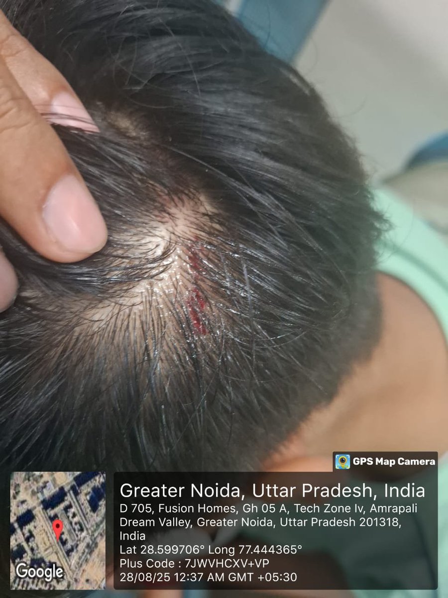manishsmooth's tweet photo. .@DCPCentralNoida @2_noida बच्चे का गला दबाकर हत्या करने की कोशिश, सिर और चेहरे पर गहरे घाव, बावजूद इसके @noidapolice ने शांतिभंग का चालान मात्र से मामला निपटा दिया? BNS-109 का FIR क्यों नहीं? @CP_Noida @dgpup @Uppolice @MinistryWCD @wpl1090 @missionshaktiup @myogioffice @UPGovt https://t.co/tRVzIp1RF6