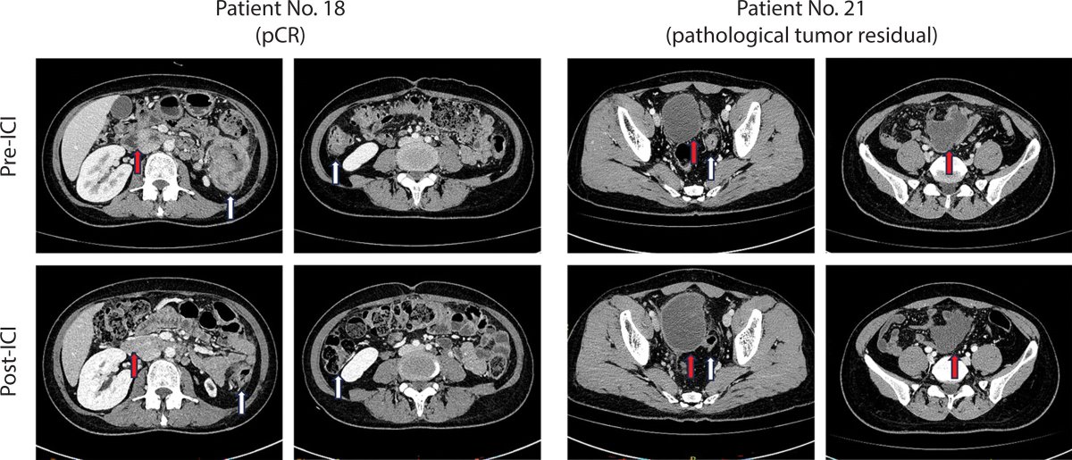 Study of pts with metastatic MMR deficient CRC undergoing surgery AFTER disease control with immune checkpoint inhibition. What factors are associated with relapse-free survival. Read more in this month's #DCRJournal: bit.ly/47Orgen