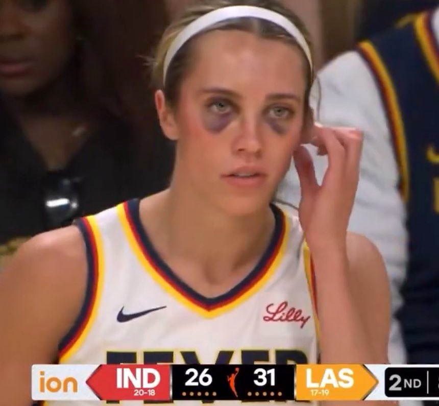 Nah man getting TWO BLACK EYES from playing a basketball game is crazy. The WNBA is wild lmaooo