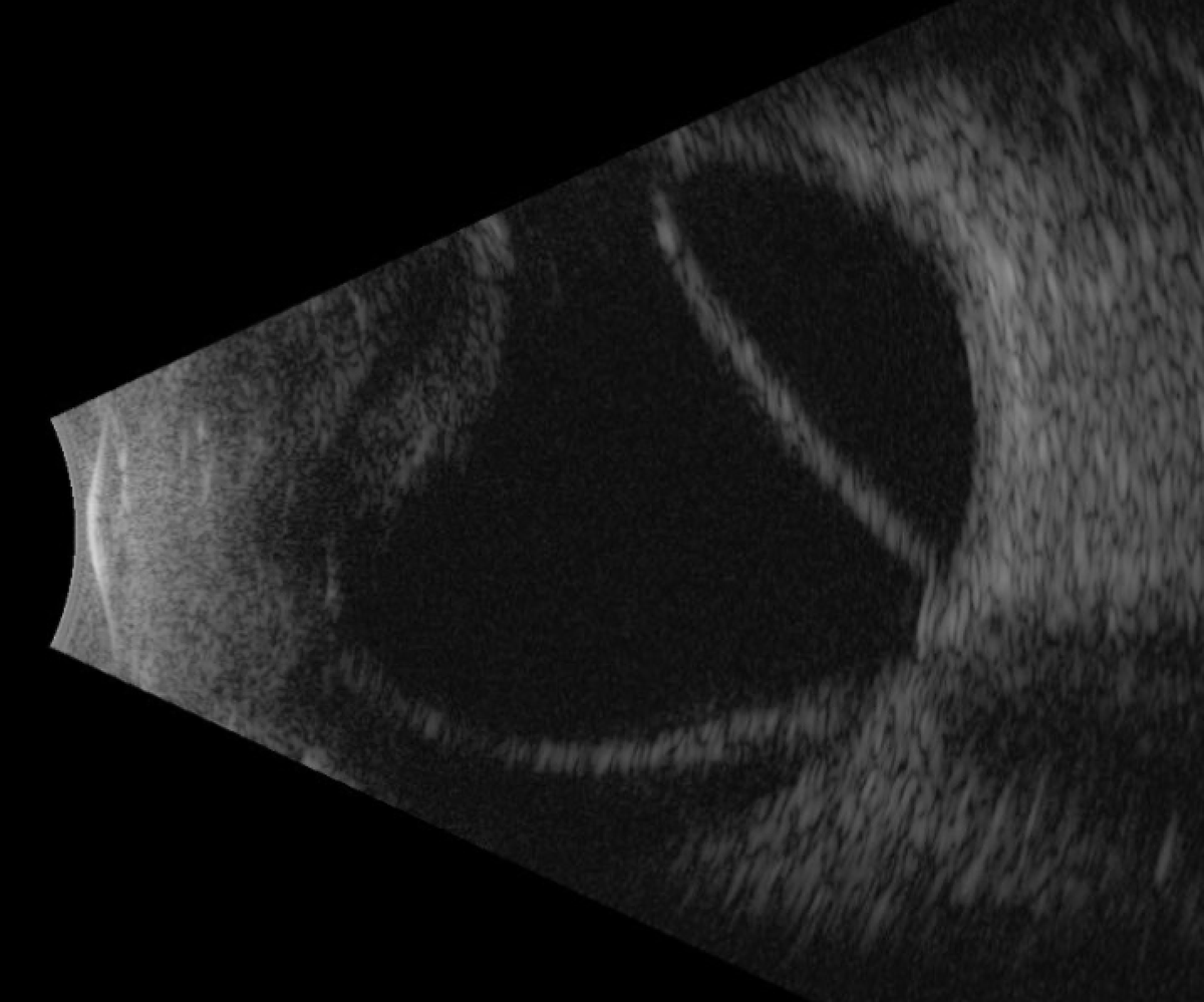 Chronic total retinal detachment.