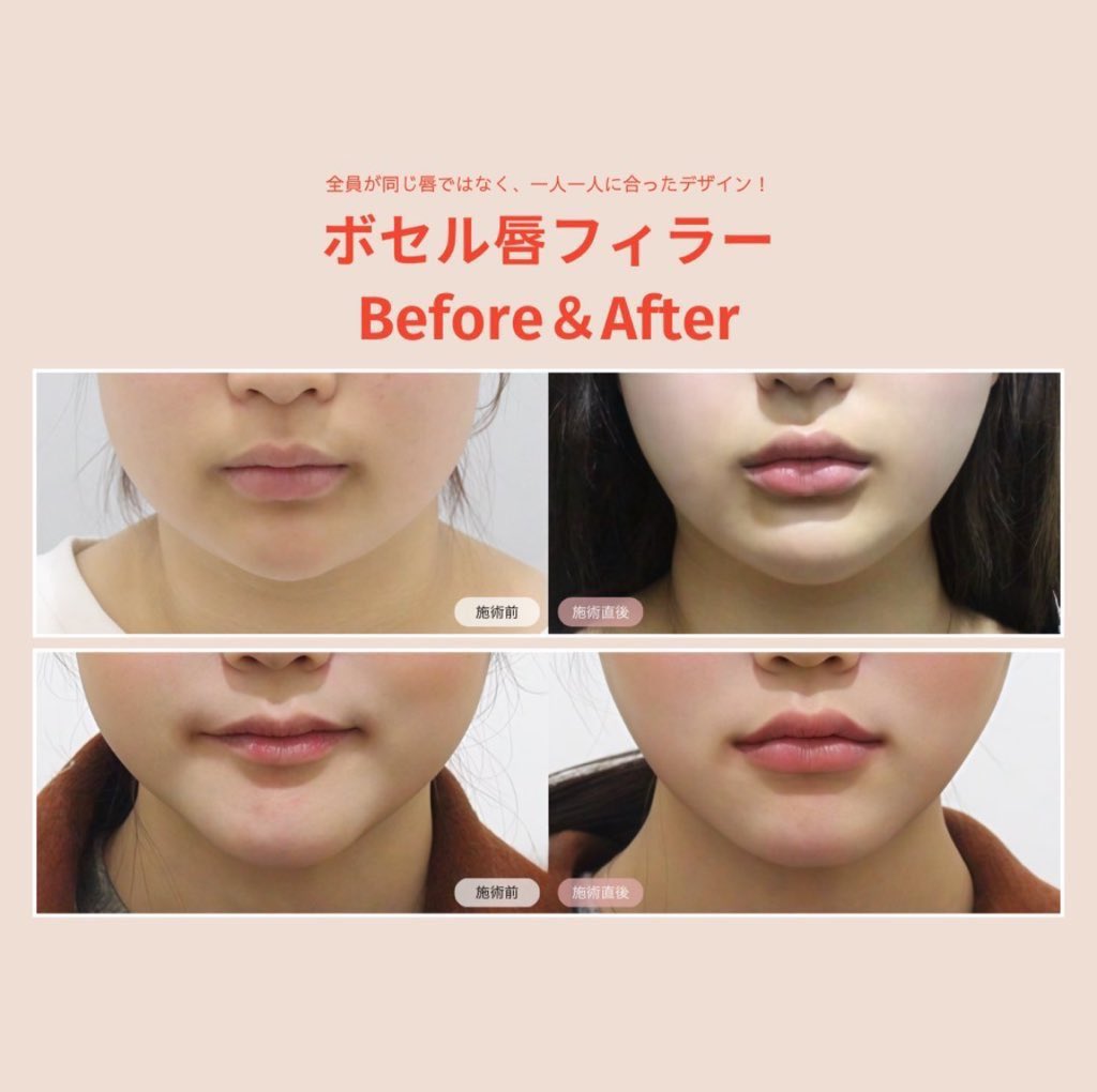 Xでバズってたボセルの唇フィラーがめっちゃ可愛かったから私もしてきた！
自然だけどナチュラルに変化出してもらえて大大大満足💕

私の希望
1.ナチュラル
2.ボリュームより横幅を少し足して小顔に見えるように
3.人中が短く見えるように

真顔でも口角上がってて嬉しい✨