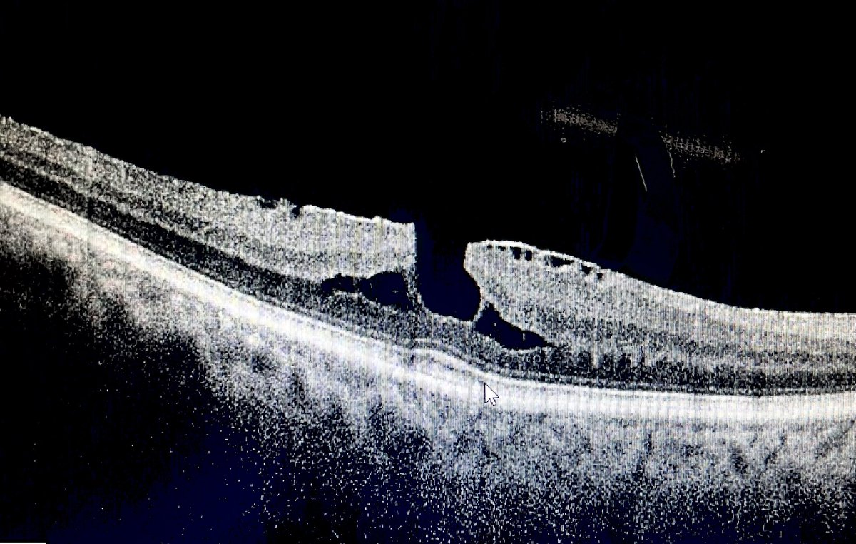 Diagnosis :
• Epiretinal Membrane
• PseudoMacular Hole 
• Splitting of Retinal layers

Management :
• Mostly observe unless significant metamorphosis/DOV
• In Severe Cases : VIT+ERM Removal

💎 Observe till you can
#Ophthalmology #MedTwitter