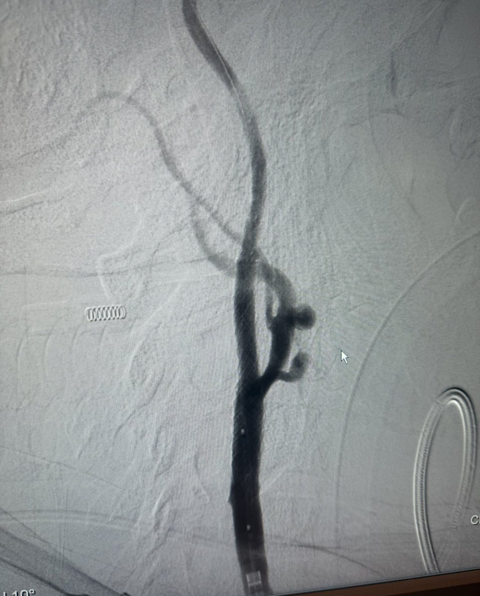 AlAli Meshari , MD د.مشاري العلي (@mesharyalali) on Twitter photo Successful carotid artery stenting in near total occlusion symptomatic stenosis case.
🧠 Timely intervention is key to stroke prevention.
#Neurointervention #StrokePrevention #CarotidStenting #Endovascular Successful carotid artery stenting in near total occlusion symptomatic stenosis case.
🧠 Timely intervention is key to stroke prevention.
#Neurointervention #StrokePrevention #CarotidStenting #Endovascular