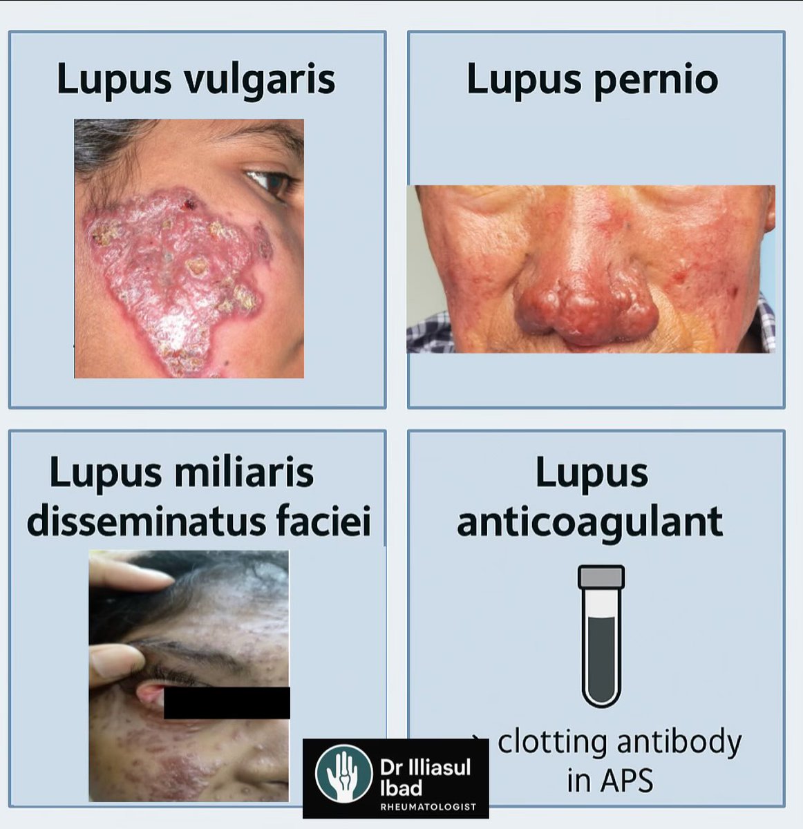 ILLIASUL IBAD (@illiasulk) on Twitter photo Not everything with “lupus” is lupus! 🐺❌
Some diseases carry the name but have nothing to do with systemic lupus erythematosus (SLE). Let’s clear the confusion
1️⃣ Lupus vulgaris
➡️ Chronic cutaneous TB 🦠
➡️ Painful nodules & ulcers, often disfiguring (“wolf-bite” scars)
2️⃣ Not everything with “lupus” is lupus! 🐺❌
Some diseases carry the name but have nothing to do with systemic lupus erythematosus (SLE). Let’s clear the confusion
1️⃣ Lupus vulgaris
➡️ Chronic cutaneous TB 🦠
➡️ Painful nodules & ulcers, often disfiguring (“wolf-bite” scars)
2️⃣