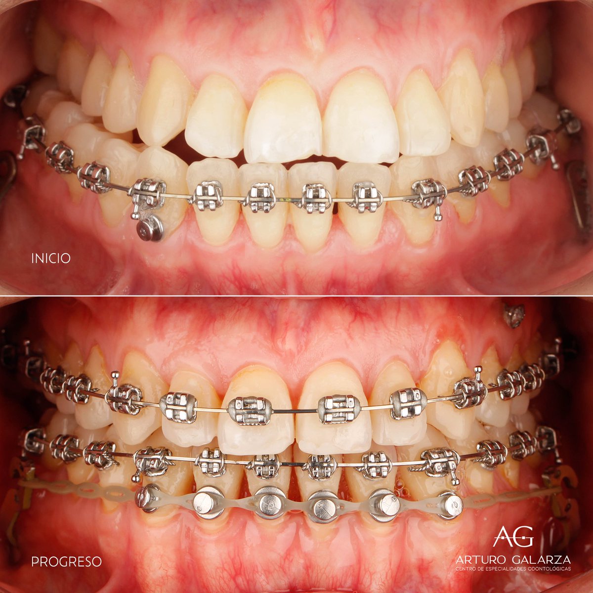dr_galarzac's tweet photo. ✨Les muestro este excelente progreso el cual manejamos de manera interdisciplinaria, con una preparación ortoquirurgica no convencional pudimos llegar a la Cirugía Ortognatica + SARPE👏🏻

👨🏻‍⚕️Especializado en Ortodoncia en México🇲🇽 y Brasil🇧🇷

Contáctanos vía WhatsApp 📲 0986281693 https://t.co/NxCDr5ZfbB