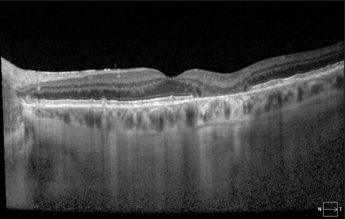 Extrafoveal geographic atrophy in an eye with dry AMD.