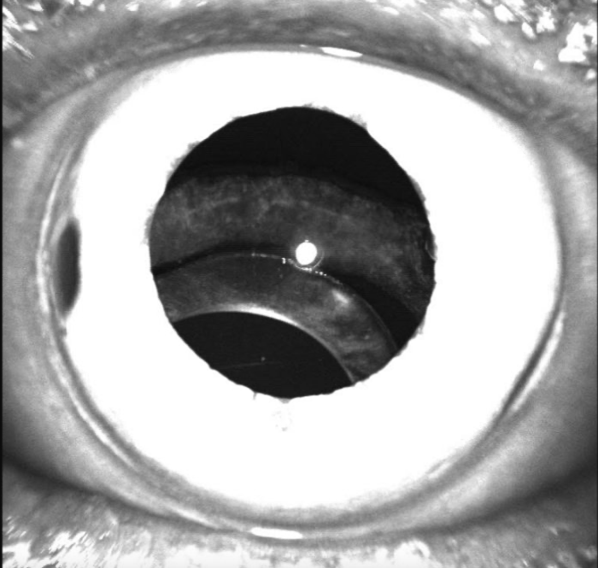 The intraocular lens and capsule complex sundowning.