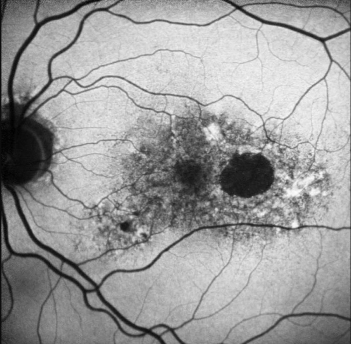 Growth of untreated geographic atrophy in eyes of one patient with dry AMD over 4 year period.