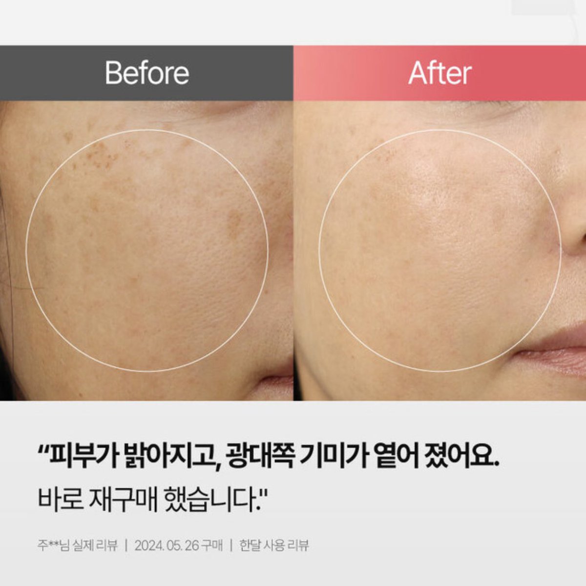 suni__fit's tweet photo. 韓国の薬局にも置かれてるシミ消しセラムで有名なRedance、1ヶ月でガチでこの位シミと色素沈着薄くなる
韓国でナイアシンアミド最大含量の5%配合
他にもシミに着目した原料を独自に��発して、韓国国内で独占使用してるの強
吸収率上がるリポソーム技術取り入れてるのもここまで効果感じられる理由そう https://t.co/l2gMEACqaC
