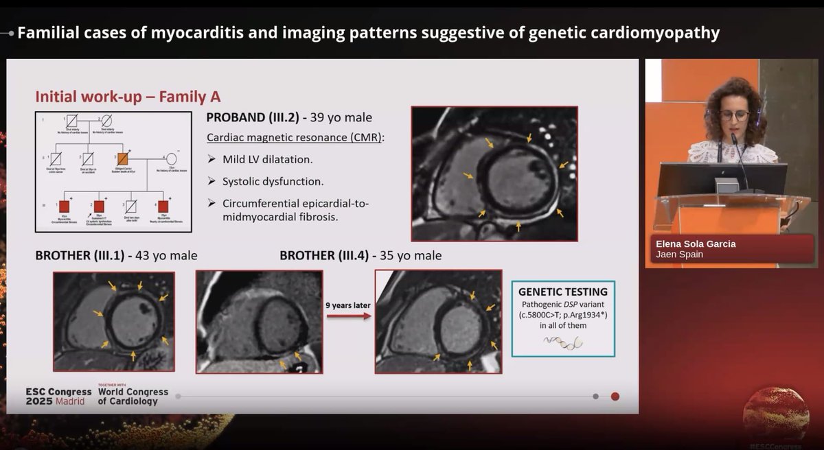 Happy to be at the #ESCCongress2025 in Madrid, exploring myocarditis, inflammation, and arrhythmic risk in arrhythmogenic cardiomyopathy. 🫀🔬