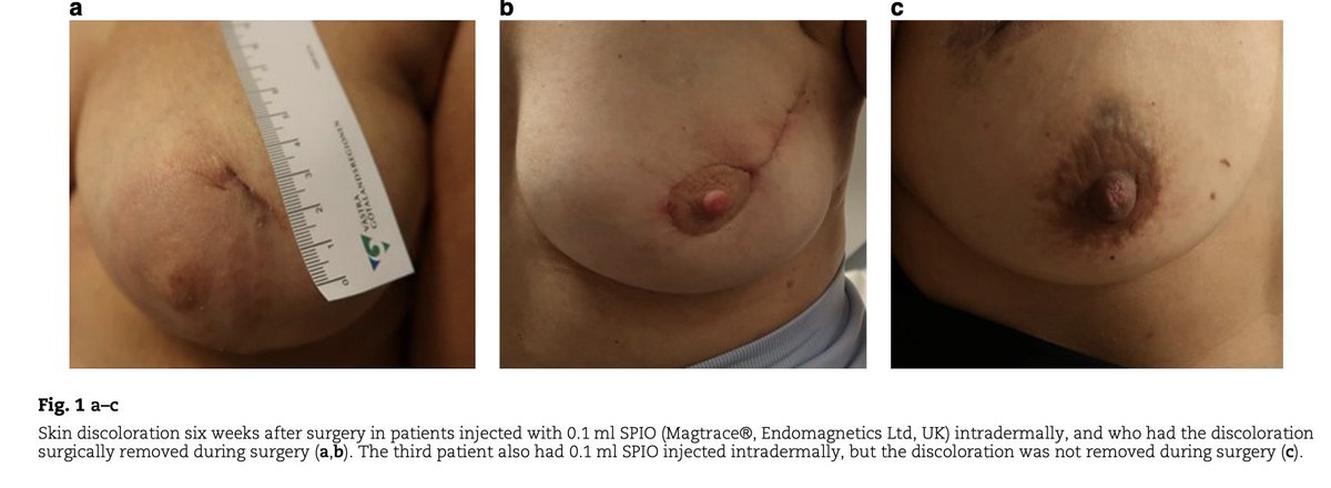 Ultra-low dose superparamagnetic iron oxide nanoparticle injection for sentinel lymph node detection in breast cancer: prospective cohort study
➡️doi.org/10.1093/bjs/zn…

🔬 A new magnetic liquid with tiny iron particles helps identify the first lymph node draining a breast