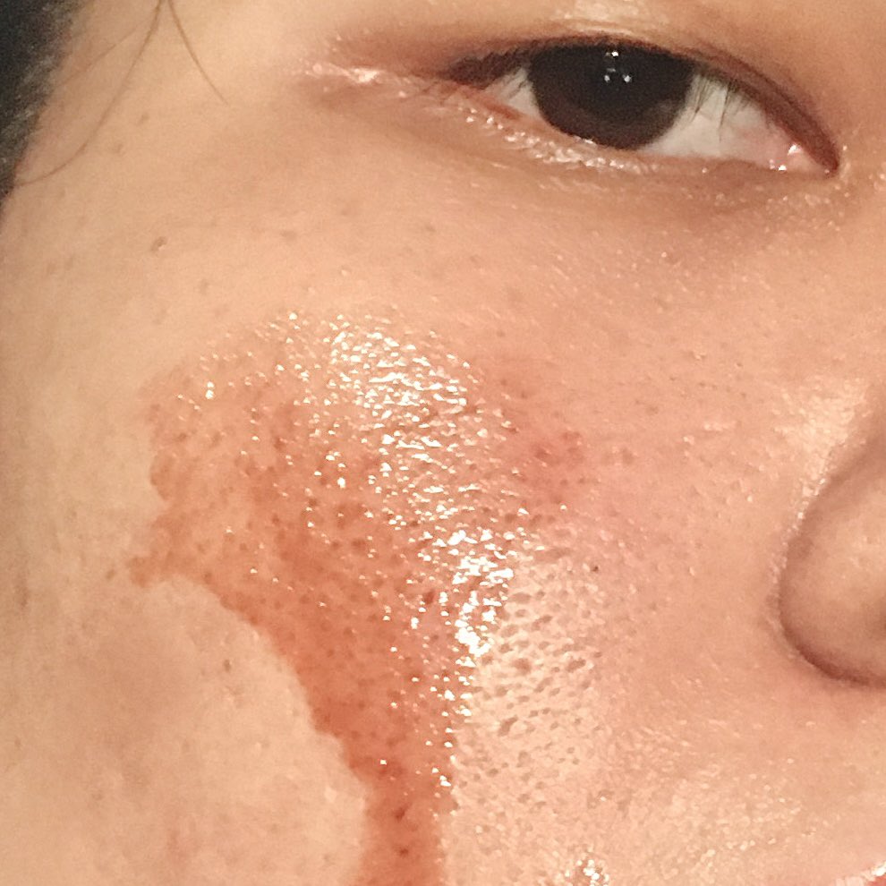 19febgirl's tweet photo. เซรั่มผลัดเซลล์ผิว ￼Glad2Glow AHA BHA PHA Intensive Peeling Solution Serum อ่อนโยน ลดรอยแดง รอยดำจากสิว กระชับรูขุมขนดีมากกกก ใช้แล้วไม่แสบผิวเลย ผิวดีขึ้นจริงง ตัวนี้ปักเป็นตัวที่ใช้ทุกอาทิตย์เลย 🩷🤍 #Glad2GlowTH 

: https://t.co/PH4OGBabhU https://t.co/aqr91FMhHR