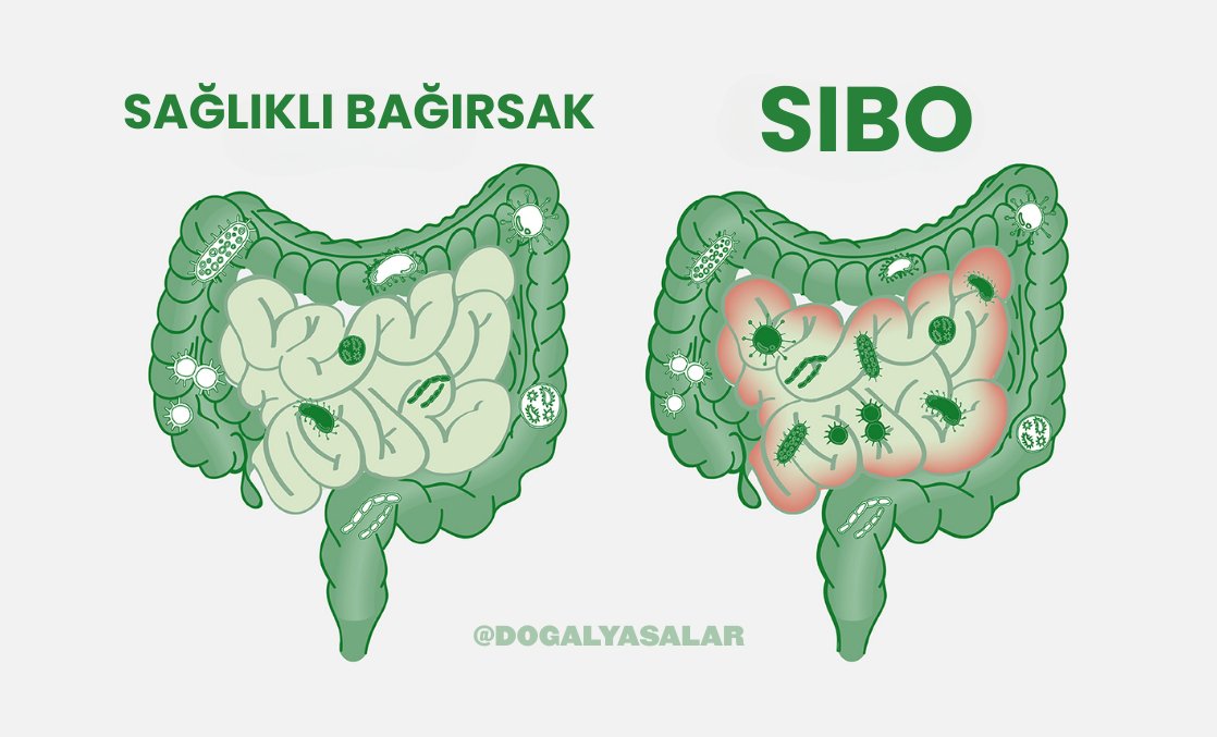 Sürekli gazın mı var?
Karnında şişkinlik mi oluyor?
Yemek yedikten sonra nabzın mı artıyor?

Reflü, huzursuz bağırsak, beyin sisi, anksiyete, çınlama, kilo verememe?

→ Sebep SIBO olabilir. 🧵

Ve %70 kişi farkında bile değil.

SIBO HAKKINDA GELMİŞ GEÇMİŞ EN DETAYLI THREAD 👇