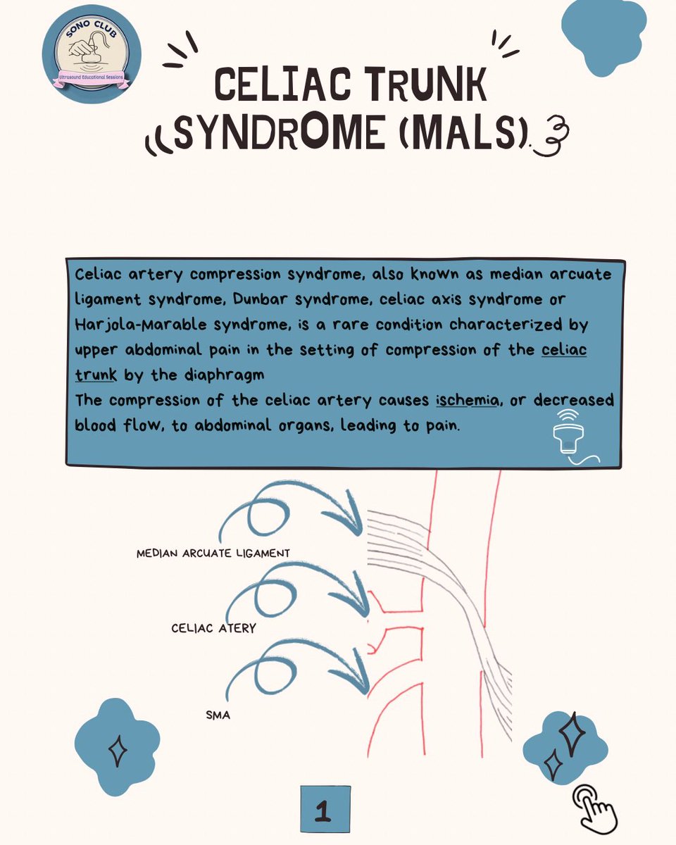 SonoClubsa's tweet photo. 🌟 Recap of our session on Median Arcuate Ligament Syndrome (MALS)! 🌟 We discussed the Seagull Sign 🦅, key symptoms 🚨, and sonographic findings 📊. Thanks to everyone for joining this enlightening discussion! 

#MedianArcuateLigamentSyndrome #MALS  #sonoclubEB #sonoclubsa #ksa https://t.co/iPpbTMDtB9