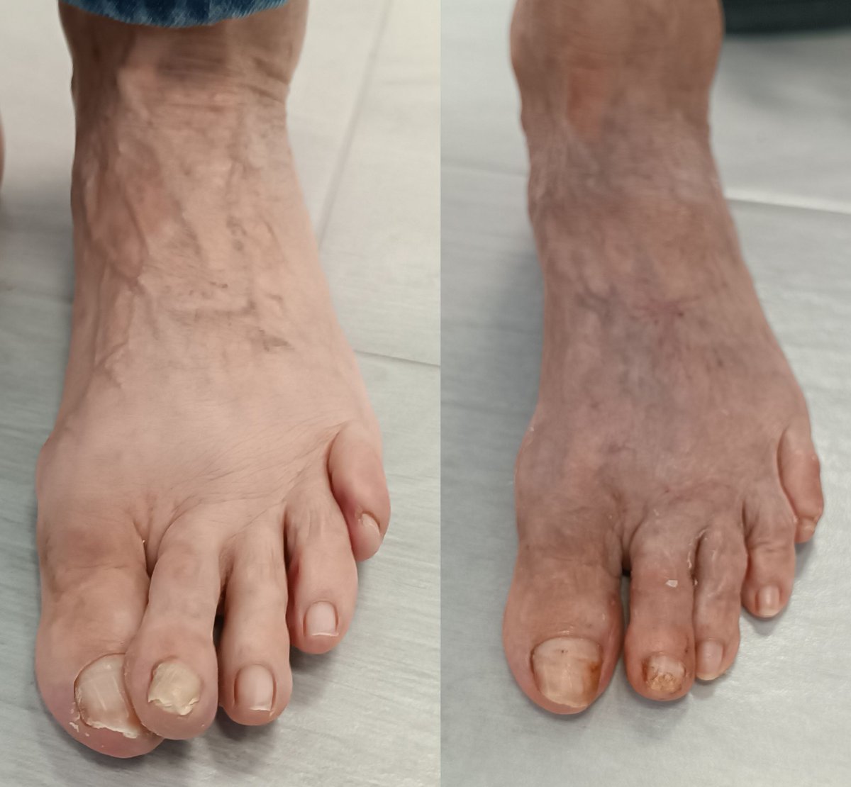 👉 ¿Sabías que los dedos en martillo no solo afectan a la estética, sino también a la forma de caminar y al confort del calzado?
Con la cirugía mínimamente invasiva conseguimos restaurar la funcionalidad del pie de forma sencilla, con una recuperación rápida y menos molestias.