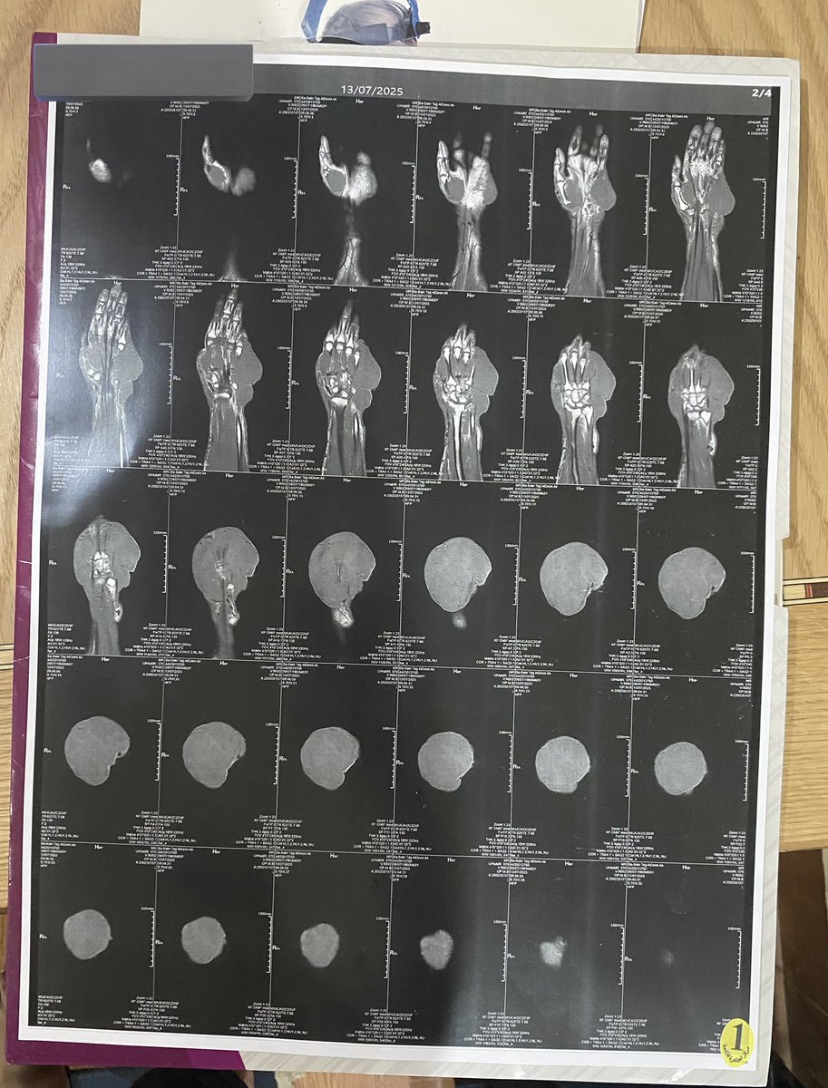 hashsudan's tweet photo. 🔴🔴حوجة عاجلة جدا  

مريض يعاني من ورم خبيث موجود في مصر وفي أمس الحاجة لدعمكم 

متبقي من تكلفة العملية : 50 ألف جنيه مصري 

للدعم بنكك : 3440826

أحمد جلال الدين 

للتواصل مع أهل المريض : 

+201505527906 https://t.co/iI57b8Ognx