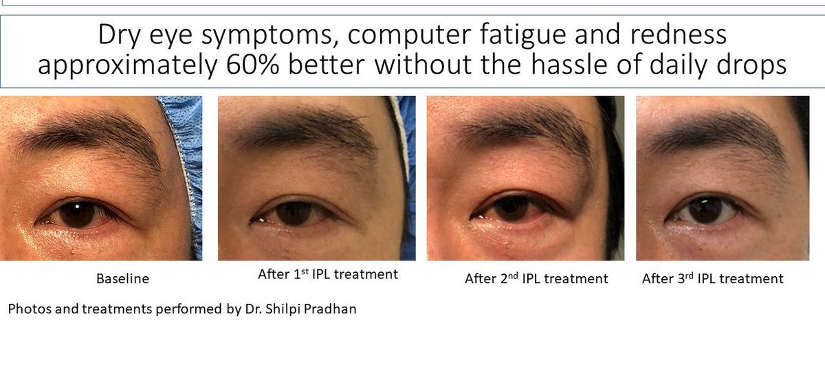 🔵 من العلاجات الثورية الحديثة لجفاف العين هو ( الموجات الضوئية المكثفة IPL ) 

وهو علاج يعمل عبر تسليط ومضات ضوئية للغدد الدهنية الموجودة على الجفن السفلي والعلوي 
ويساعد في علاج الجفاف عبر تحفيز إفراز الدمع من هذه الغدد مما يقلل الحاجة الى استخدام قطرات الترطيب والمراهم ..