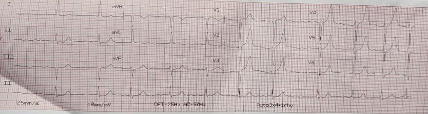 drabosalama's tweet photo. @smithECGBlog @PMcardioApp @PendellM Patient came to the ER with mild chest discomfort. After an ECG at another hospital showed no ST elevations and normal cardiac enzymes, she was discharged. We noticed hyperacute T waves and activated the cath lab, revealing a 100% obstruction in the left main stem. https://t.co/lKVy20520b