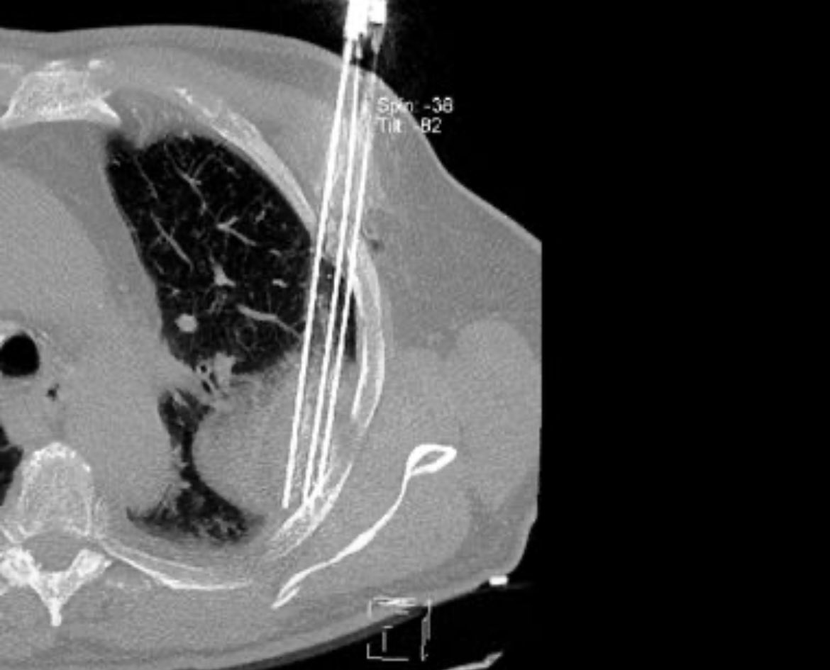 Interventional Oncology Institute tweet media