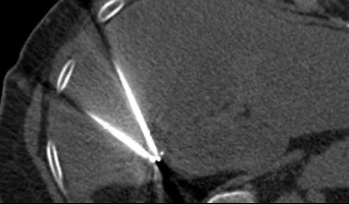 Interventional Oncology Institute tweet media