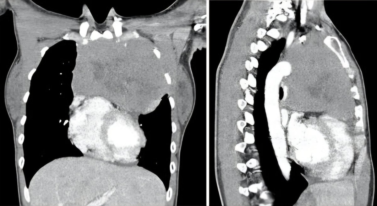 أورام الغدد اللمفاوية في المنصف غالباً تصيب فئة الشباب (15–35 سنة). قد تظهر بأعراض مثل: كحة مزمنة، ضيق تنفّس،  وتعرق اثنا النوم وارتفاع درجه الحراره. ألم بالصدر أو تورم بالرقبة. الأشعة المقطعية للصدر تلعب دور أساسي في التشخيص وتحديد مكان الورم، ودوري كجرّاح صدر  هو أخذ خزعة