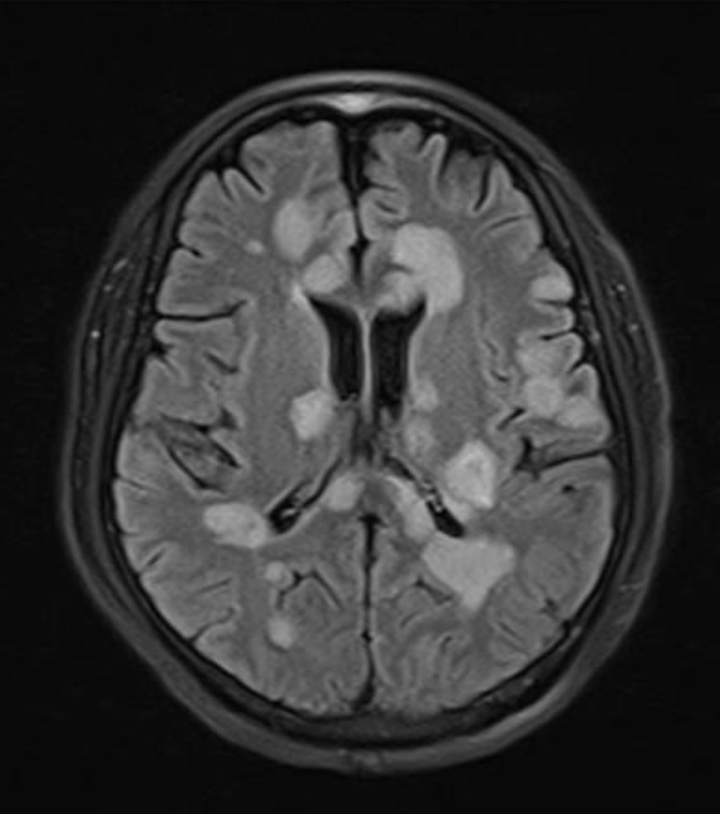 6 years old presented with encephalopathy and weakness.
Your diagnosis!!!