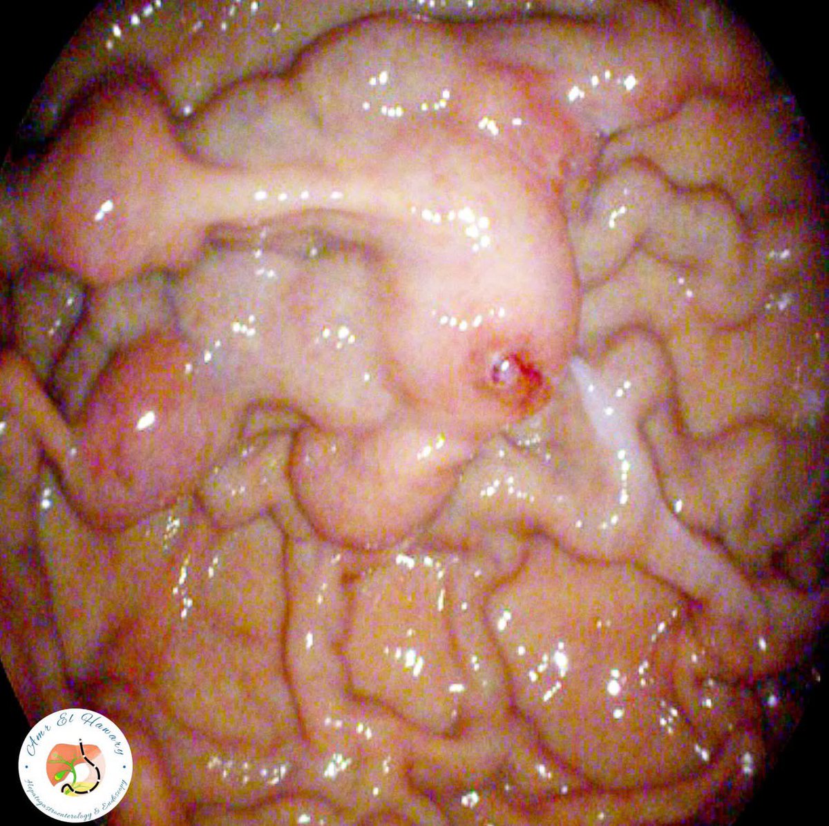 What would you think about if you saw this in the stomach?