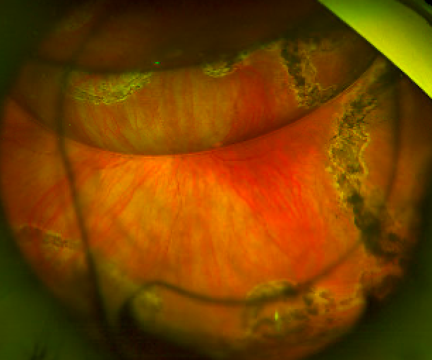 Sustained retinal re-attachment as C3F8 gas reabsorbs. 20/40 ph. In 4th image, note intraocular lens.