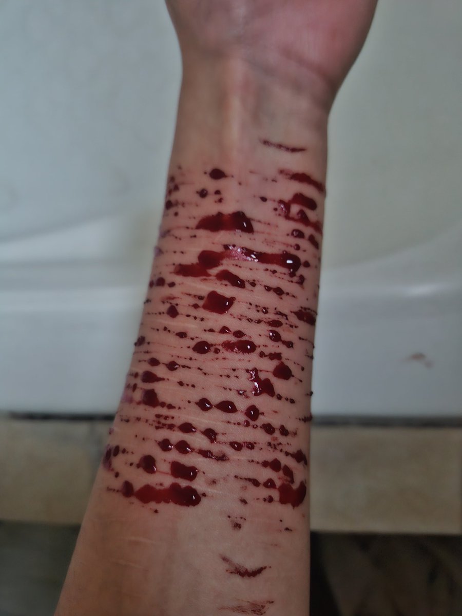 Se me ve bien gordo el brazo jejrjeje a la chingada el recov 😢☹️🤝❤️‍🩹