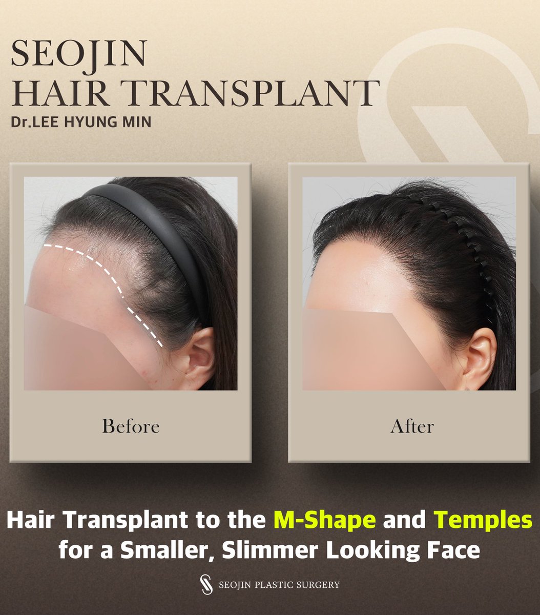 seojinps_eng's tweet photo. 💗 A hair transplant to fill in the M-shaped hairline and temples can create the look of a smaller, balanced face
ㄴ We will design the ideal hairline height and shape to suit your proportions.
#HairTransplant #ForeheadReduction #HairlineCorrection #Hairloss #Kbeauty #Kpop https://t.co/6WzZpXbM4R