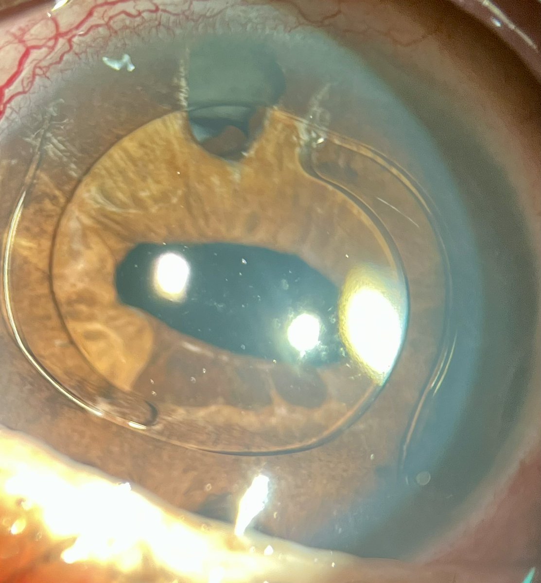 𝐀𝐧𝐭𝐞𝐫𝐢𝐨𝐫 𝐂𝐡𝐚𝐦𝐛𝐞𝐫 𝐈𝐎𝐋

Checklist is you see this patient ▶️

1️⃣ Watch corneal endothelium (edema / cell loss

2️⃣ Check IOL position &amp; stability

3️⃣ Examine angle (PAS / crowding / glaucoma)

4️⃣ Look for iris changes (pigment / UGH)

5️⃣ Monitor IOP &amp; optic nerve