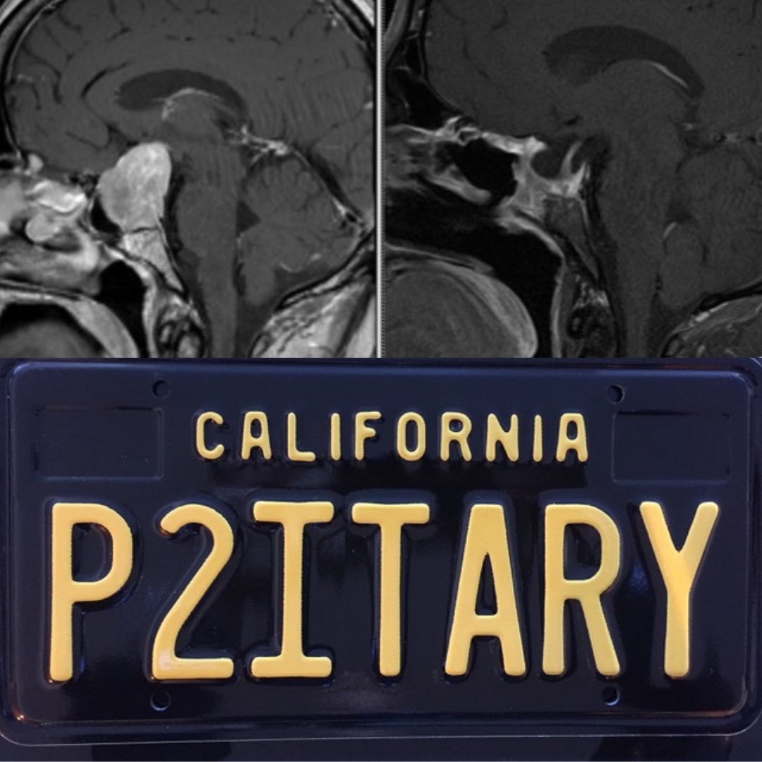 Gabriel Zada, MD, MS (@doctorzada) on Twitter photo New study in <a href="/TheJNS/">Journal of Neurosurgery</a> led by Dr John Pham (NCDB, 100k+ pts):
🏥 High-volume centers →
↑ Surgery & endoscopic approaches
↓ Radiotherapy, LOS, & mortality
Centralized, multidisciplinary care = better outcomes for PAs.
#Neurosurgery #Pituitary #Endocrinology <a href="/USCBTC/">USC Brain Tumor Center (uscbtc)</a> New study in <a href="/TheJNS/">Journal of Neurosurgery</a> led by Dr John Pham (NCDB, 100k+ pts):
🏥 High-volume centers →
↑ Surgery & endoscopic approaches
↓ Radiotherapy, LOS, & mortality
Centralized, multidisciplinary care = better outcomes for PAs.
#Neurosurgery #Pituitary #Endocrinology <a href="/USCBTC/">USC Brain Tumor Center (uscbtc)</a>
