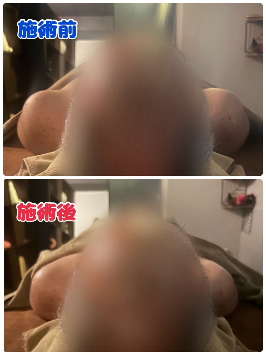 巻き肩矯正のビフォアフお写真
撮らせて下さった皆様
ありがとうございました☺️🤍

「改めて写真で見るとすごい変化だね！」
と笑顔になって頂けて嬉しい限りです🥺

姿勢が変わると呼吸がかわる
呼吸がかわると気持ちに余裕ができる

そのお手伝いができるよう
これからも精進します🙏✨