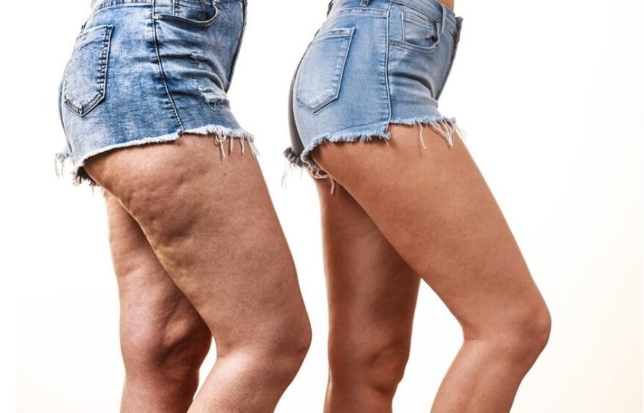 Selülit masajı

*Vücuda uygulanan klasik masaj tekniklerinden farklı
*Cilde yuvarlama ve sıkıştırma
*Masaj yapılacak bölgeye öncesinde limon lavanta jojoba biberiye ve kekik gibi yakıcı yağlar sürülür
*Yağ dokularının parçalaması

#adana #mersin #seyhan #çukurova