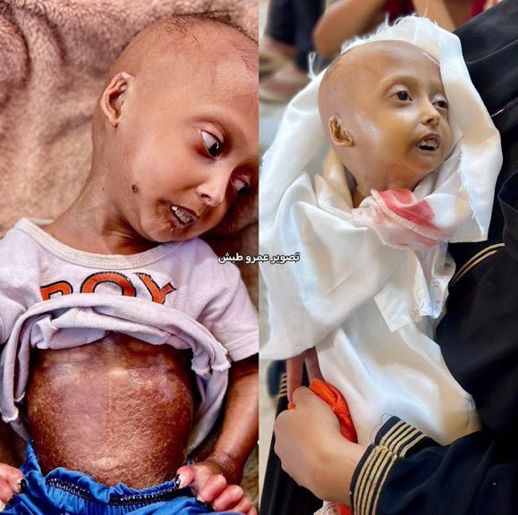 HalaJaber's tweet image. 🥀 Hala al-Hanadi, 4 years old, my namesake, died today from lack of medication &amp;amp; severe malnutrition. Another child starved by Israel’s blockade… Another life stolen.