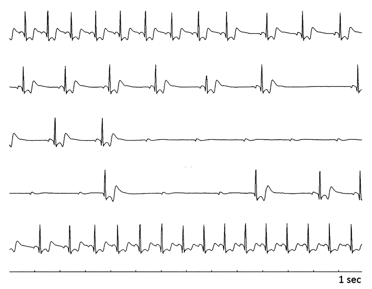 Aakash Tuli (@aakashtulimd) on Twitter photo 1/ Vagally mediated bradycardia - Pathological or a physiological finding? Time for a pacemaker? Let's break it down 🧵
#Tweetorial #MedEd #CardioX
🚨 <a href="/ACCinTouch/">American College of Cardiology</a> <a href="/CCCEnthusiasts/">CCC Enthusiasts</a>
🛌 Patient admitted with abdominal pain develops "bradycardia with AV block" overnight. Telemetry 1/ Vagally mediated bradycardia - Pathological or a physiological finding? Time for a pacemaker? Let's break it down 🧵
#Tweetorial #MedEd #CardioX
🚨 <a href="/ACCinTouch/">American College of Cardiology</a> <a href="/CCCEnthusiasts/">CCC Enthusiasts</a>
🛌 Patient admitted with abdominal pain develops "bradycardia with AV block" overnight. Telemetry