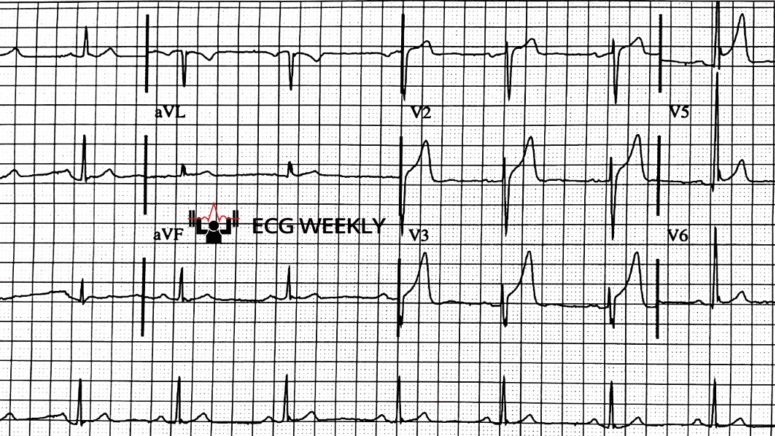 A 55-year-old man with PMHx of hyperlipidemia presents to the emergency department with vague chest discomfort. The following ECG is obtained.....ecgweekly.com/weekly-workout…