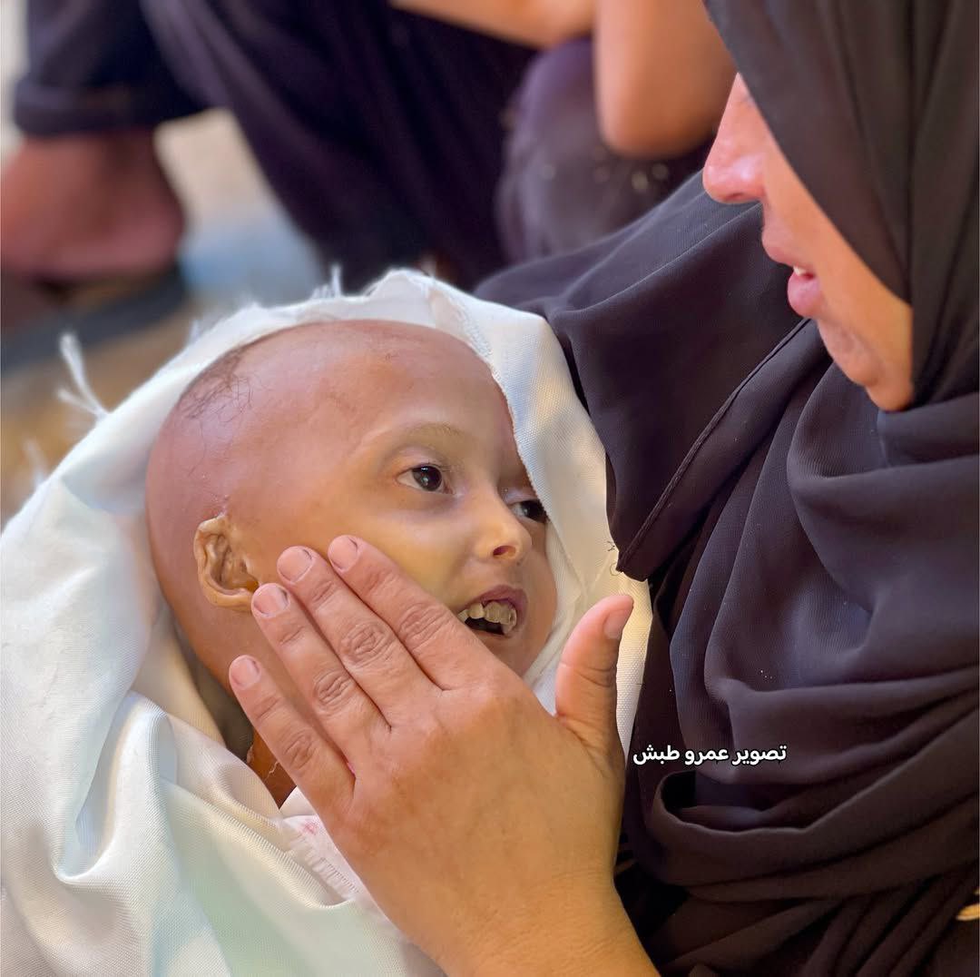 (Hassas içerik) Gazzeli 4 yaşındaki Hala Hanadi, şiddetli açlık ve tıbbi bakım eksikliği nedeniyle hayatını kaybetti.