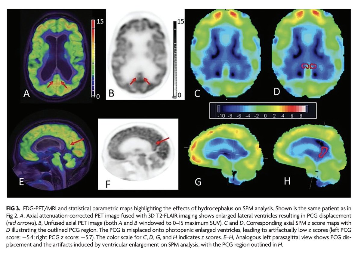 AJNR (@theajnr) on Twitter photo "Implications of Hydrocephalus on FDG-PET Statistical Parametric Mapping Analysis in Neurodegenerative Disease Evaluation"
doi.org/10.3174/ajnr.A…
<a href="/jana_ivanidze/">Jana Ivanidze</a>; <a href="/AndresRicaurte1/">Andres Ricaurte Fajardo</a> "Implications of Hydrocephalus on FDG-PET Statistical Parametric Mapping Analysis in Neurodegenerative Disease Evaluation"
doi.org/10.3174/ajnr.A…
<a href="/jana_ivanidze/">Jana Ivanidze</a>; <a href="/AndresRicaurte1/">Andres Ricaurte Fajardo</a>