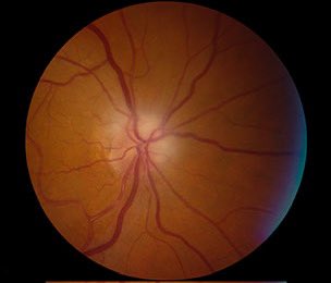 🚨 إبر مونجاور وأوزمبيك التي تستخدم لعلاج السكري والسمنة وتأثيرها على العين ؟ 

   🔻لاتوجد أي دراسة تؤكد وجود رابط أو علاقة واضحة بين استخدامها وتأثيرها على العين والعصب البصري .. 
  🔻بعد نقاش مع مجموعة مميزة من الزملاء الاستشاريين المختصين بشبكية العين والعصب البصري : 
   ✔️