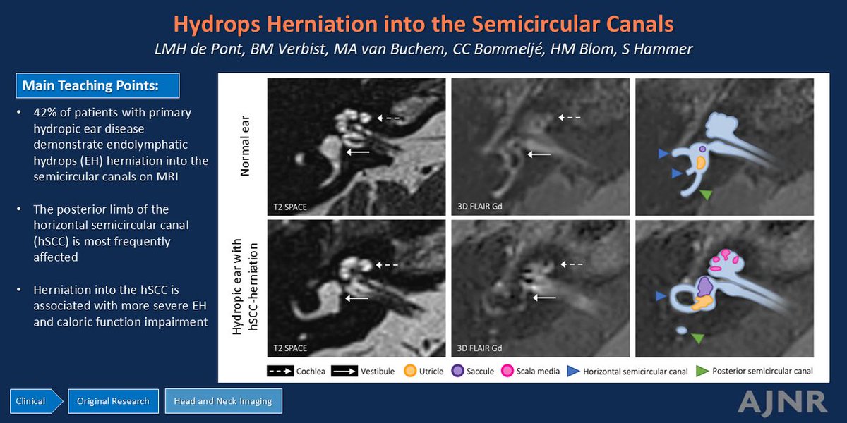 TheAJNR's tweet photo. "Prevalence of Endolymphatic Hydrops Herniation into the Semicircular Canals in Primary Hydropic Ear Disease: Correlation with Clinical and Radiologic Parameters"

https://t.co/TB77aYRlNC https://t.co/Hg4ztDjaf2