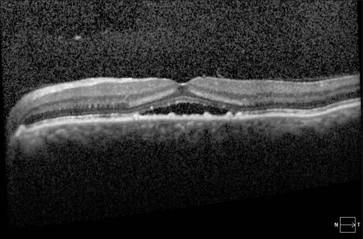 Chronic central serous retinopathy - starting, worsening, resolving - over 7 month period.
