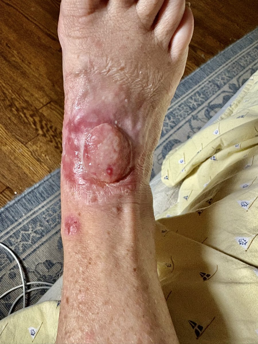 Radiation on an external 5cm foot tumor is the worst pain I’ve ever experienced. This includes multiple  tumors; chronic esophagitis; chest tubes, trachs. Week 5 of 6. Likely another week + a boost to go.