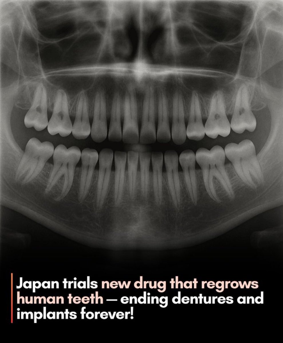 And Please Please stop 🛑 removing you're wisdom tooth 🦷#whynot #Dentistry #Ethiopia