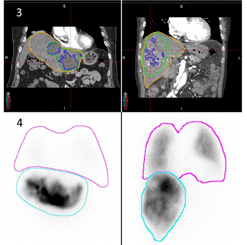 Monica Cheng, MD (@monicacheng_) on Twitter photo Contrast enhanced CT-derived hypervascular-tumor-to-perfused volume ratio may offer a non-invasive alternative to 99mTc-MAA for lung shunt fraction estimation in hepatic transarterial radioembolization <a href="/RSNA/">RSNA</a> #RadAdv <a href="/OxfordJournals/">Oxford Journals</a> <a href="/SusannaLeeRad/">Susanna I Lee</a> doi.org/10.1093/radadv… Contrast enhanced CT-derived hypervascular-tumor-to-perfused volume ratio may offer a non-invasive alternative to 99mTc-MAA for lung shunt fraction estimation in hepatic transarterial radioembolization <a href="/RSNA/">RSNA</a> #RadAdv <a href="/OxfordJournals/">Oxford Journals</a> <a href="/SusannaLeeRad/">Susanna I Lee</a> doi.org/10.1093/radadv…